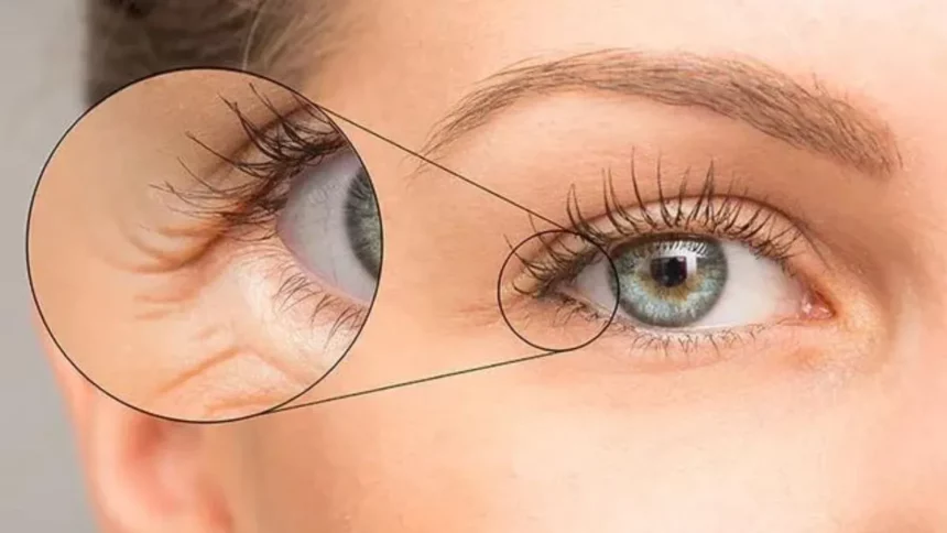 Remedies for Eye Wrinkles
